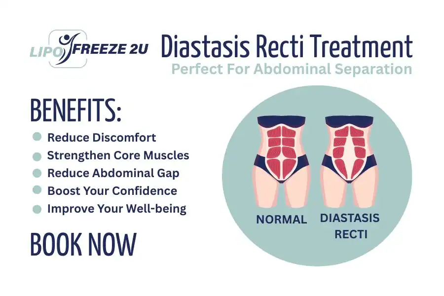 Benefits of body toning treatment Swansea for Diastasis recti