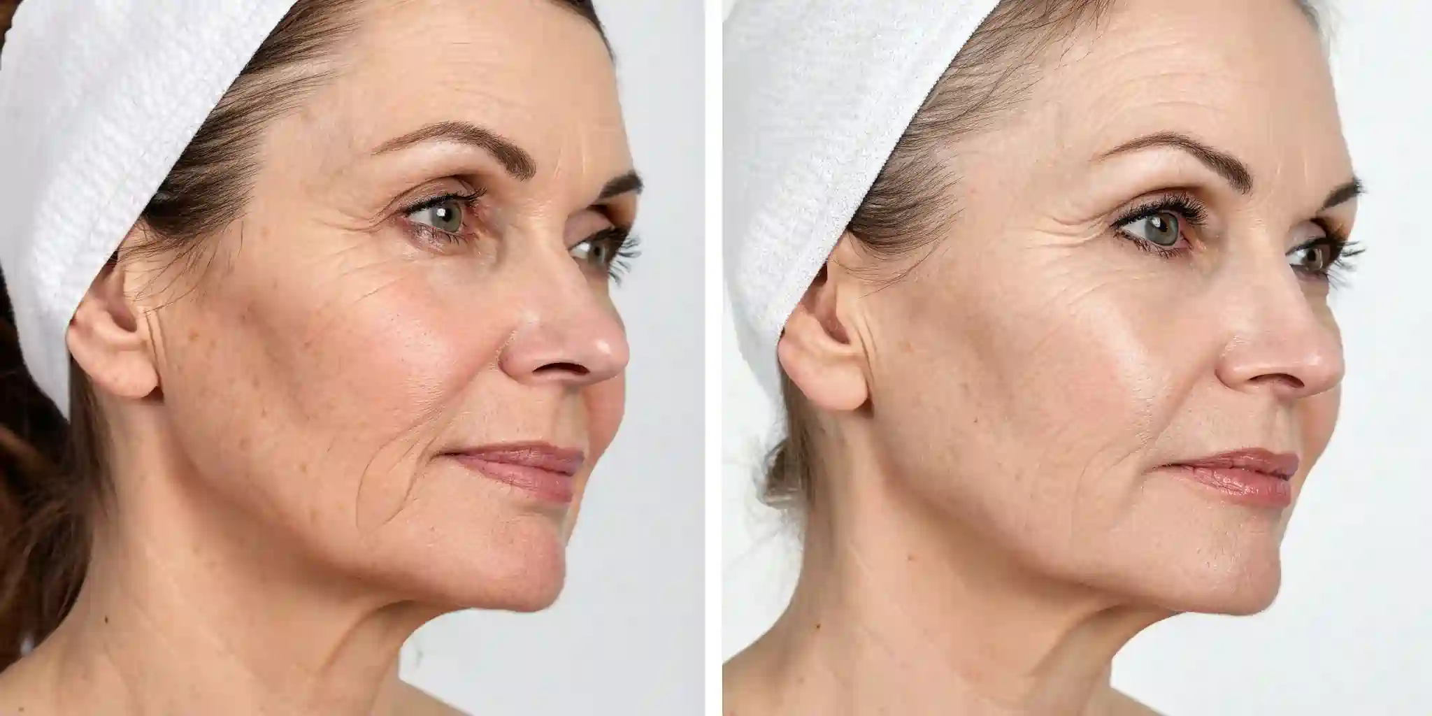 Common Questions About RF Microneedling and Loose Skin Swansea