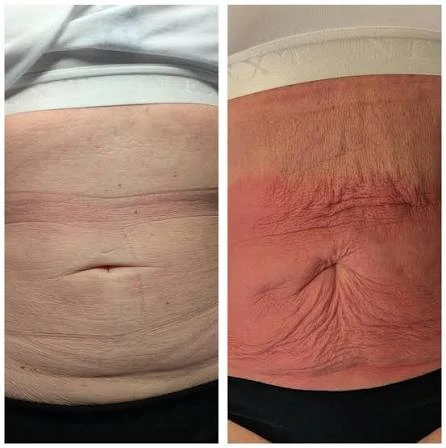 How Does RF Microneedling Improve Crepey, Thin and Uneven Skin Texture Swansea?