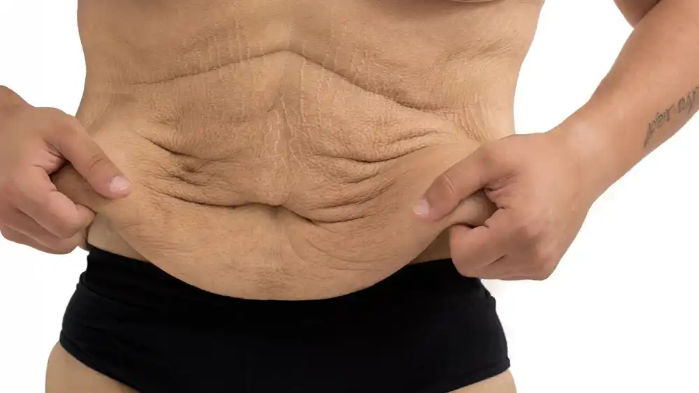 RF Microneedling for Loose Skin: How Can It Help Tighten and Reshape the Skin Swansea?